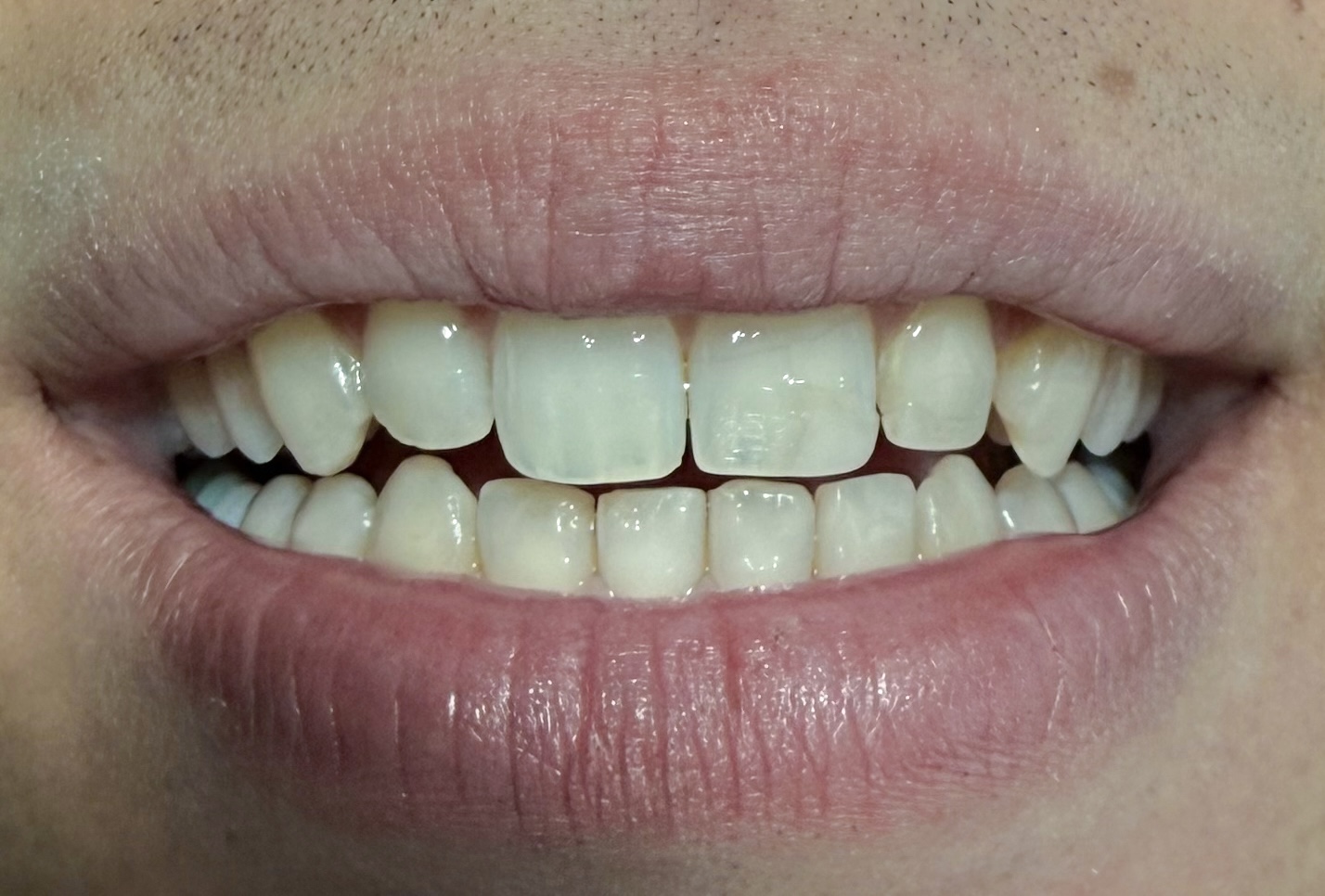 Whitening before treatment